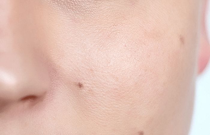 After skin smoothing After skin smoothing